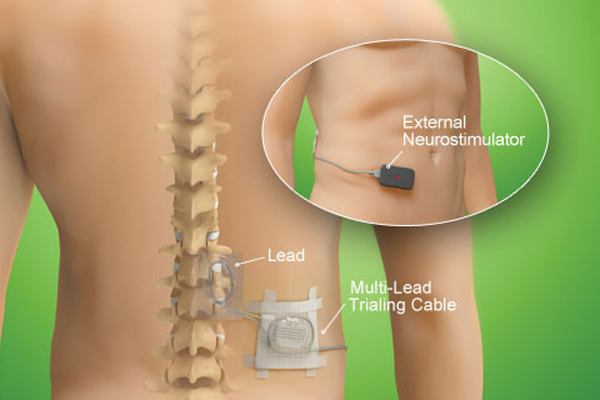 Dorsal Column Stimulators