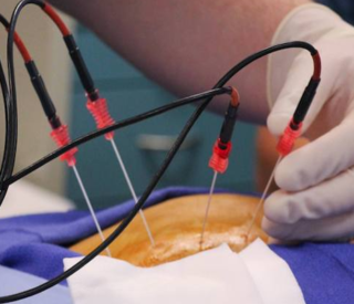 Radio Frequency Ablation